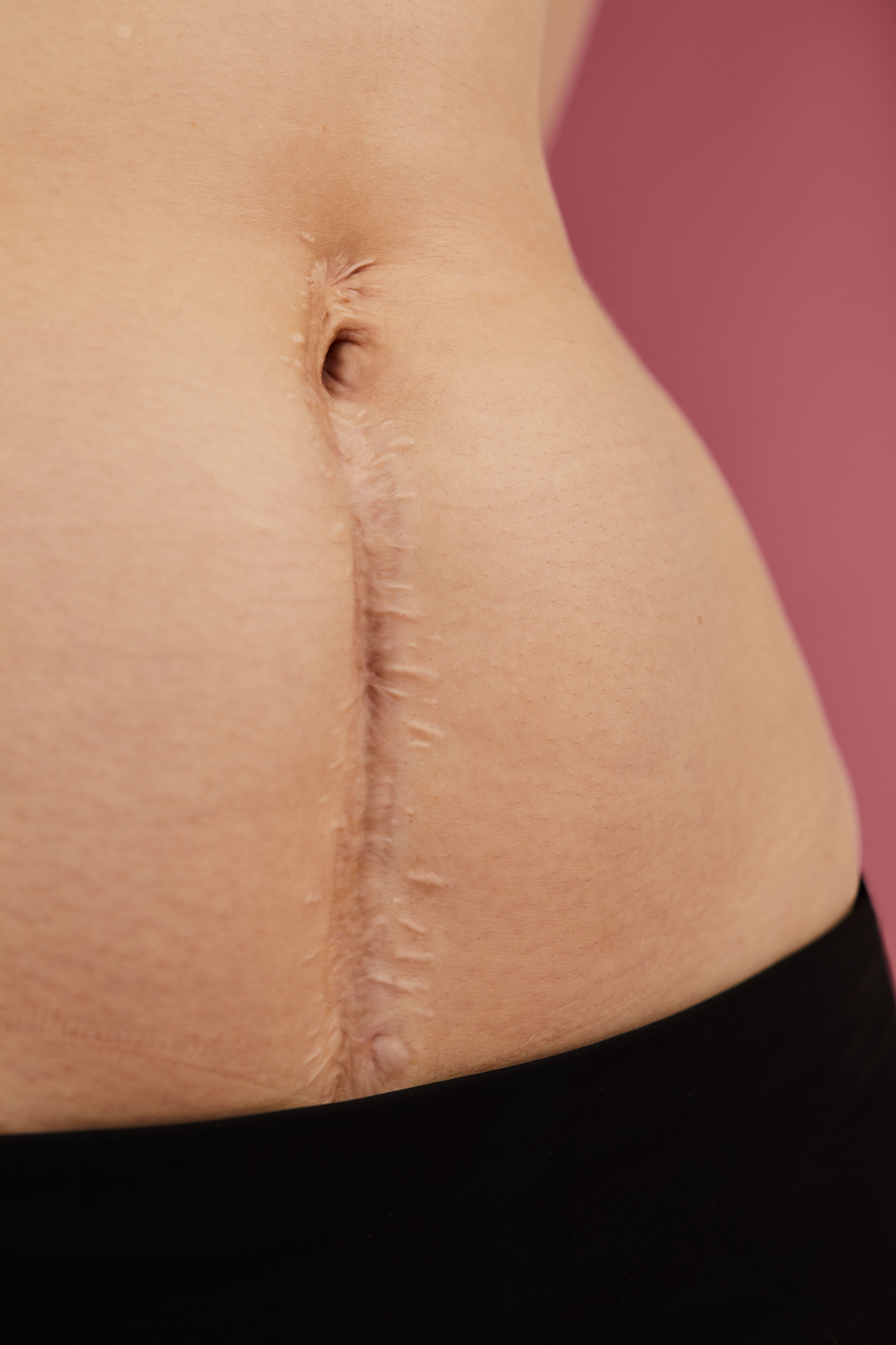 Grazia | My Scars Tell My Story